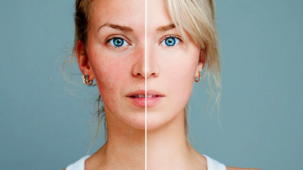Как снять покраснение кожи перед макияжем