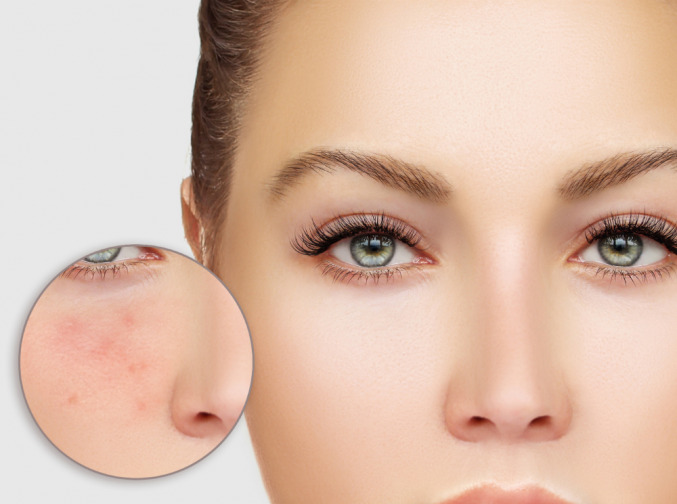 Как подготовить кожу с акне к макияжу: советы профессионалов